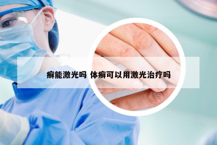 癣能激光吗 体癣可以用激光治疗吗