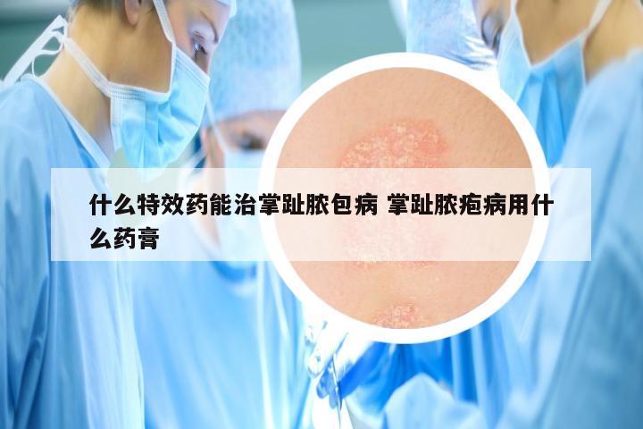 什么特效药能治掌趾脓包病 掌趾脓疱病用什么药膏