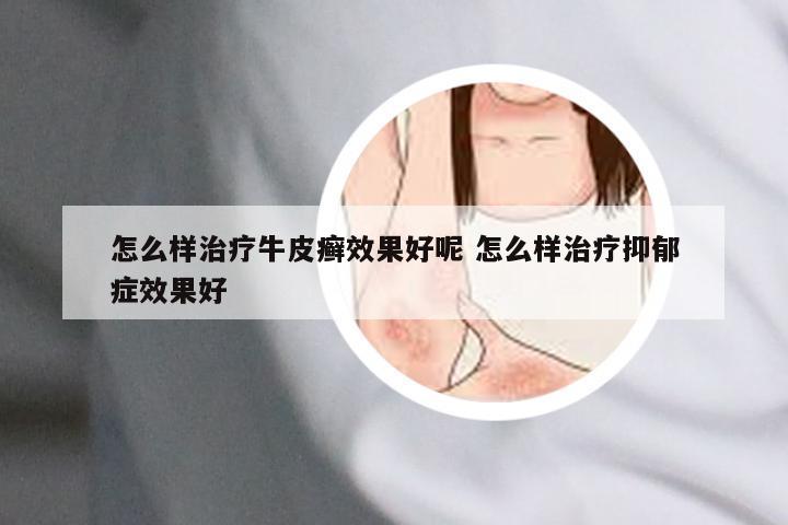 怎么样治疗牛皮癣效果好呢 怎么样治疗抑郁症效果好