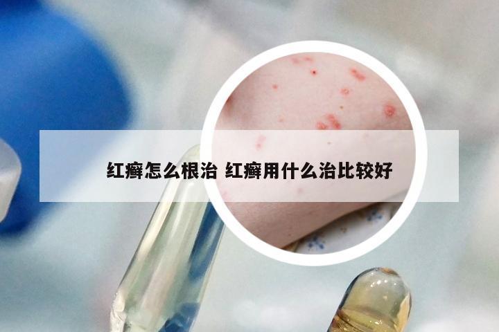 红癣怎么根治 红癣用什么治比较好