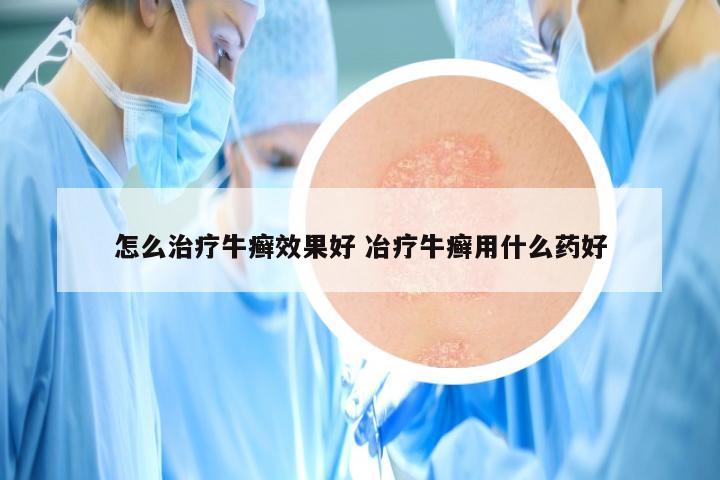 怎么治疗牛癣效果好 冶疗牛癣用什么药好