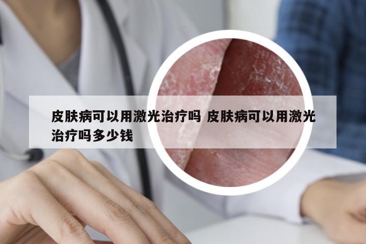 皮肤病可以用激光治疗吗 皮肤病可以用激光治疗吗多少钱