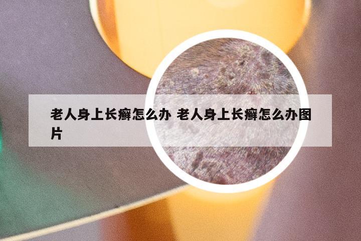 老人身上长癣怎么办 老人身上长癣怎么办图片