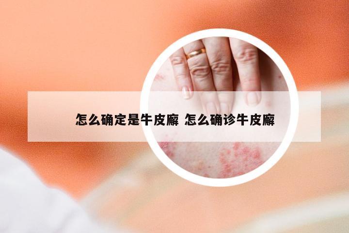 怎么确定是牛皮廨 怎么确诊牛皮廨