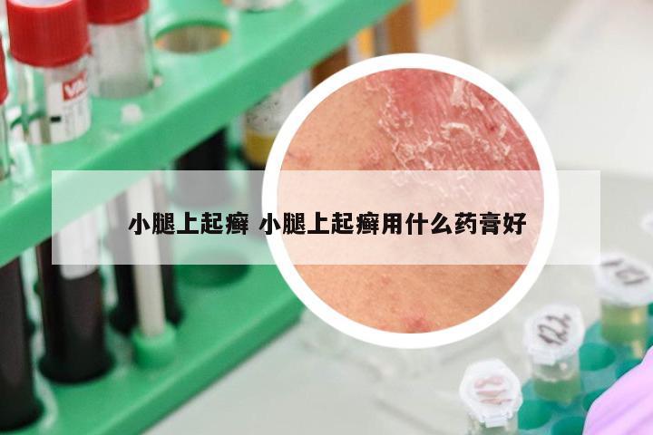 小腿上起癣 小腿上起癣用什么药膏好