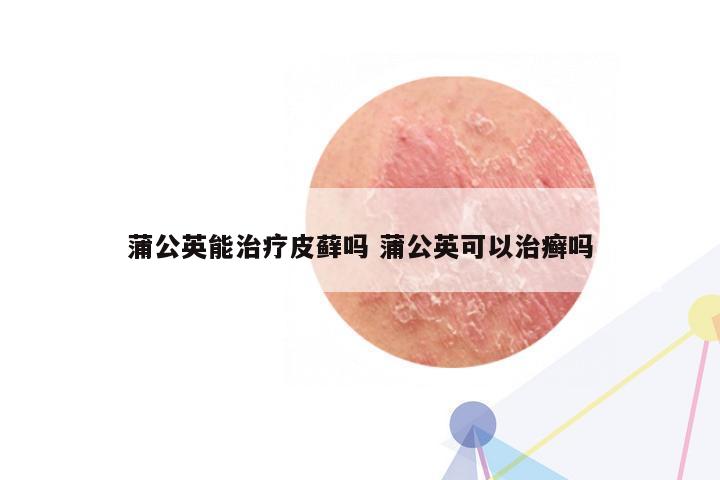 蒲公英能治疗皮藓吗 蒲公英可以治癣吗