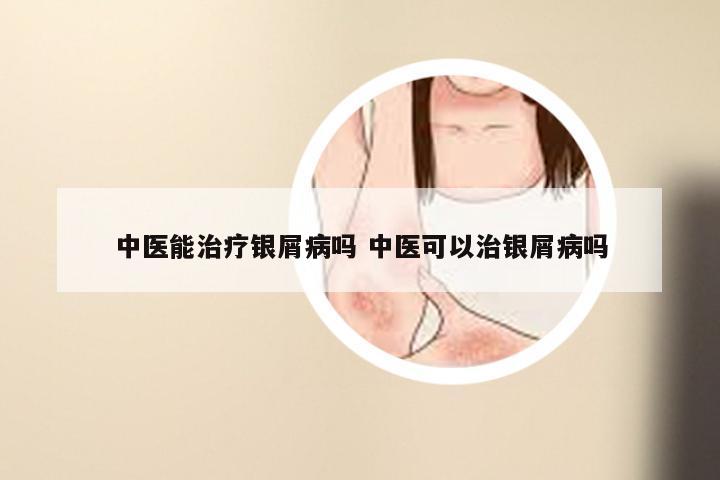 中医能治疗银屑病吗 中医可以治银屑病吗