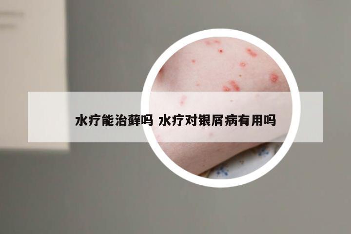 水疗能治藓吗 水疗对银屑病有用吗