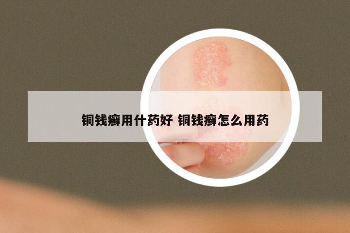 铜钱癣用什药好 铜钱癣怎么用药