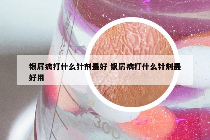 银屑病打什么针剂最好 银屑病打什么针剂最好用