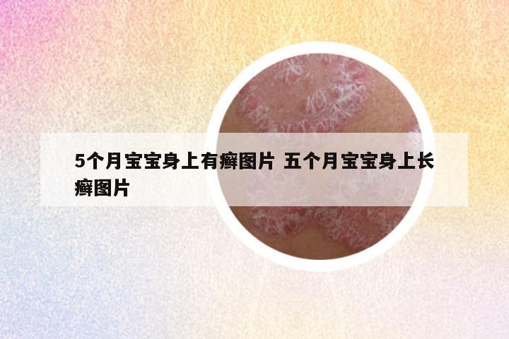 5个月宝宝身上有癣图片 五个月宝宝身上长癣图片