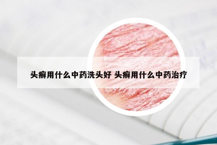 头癣用什么中药洗头好 头癣用什么中药治疗