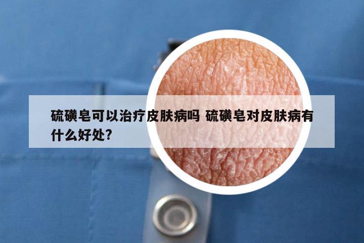 硫磺皂可以治疗皮肤病吗 硫磺皂对皮肤病有什么好处?