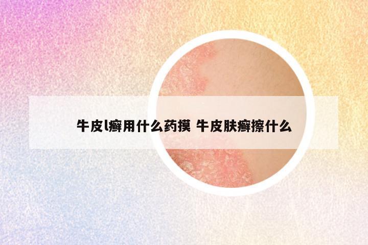 牛皮l癣用什么药摸 牛皮肤癣擦什么