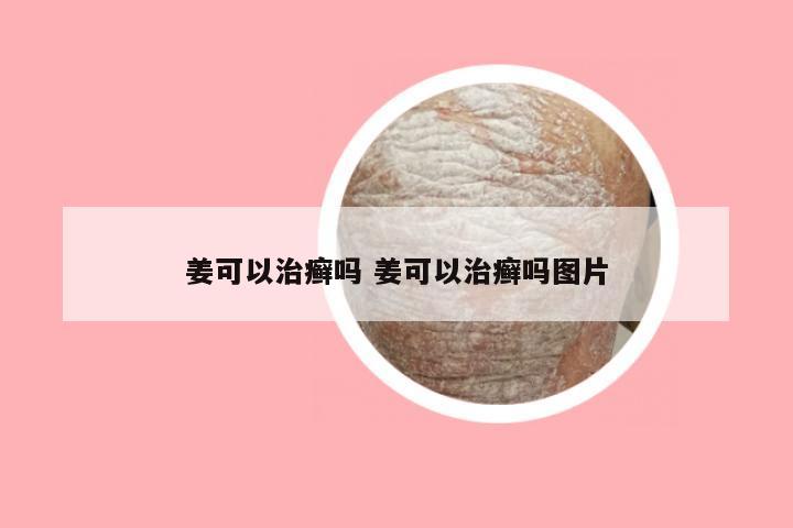 姜可以治癣吗 姜可以治癣吗图片