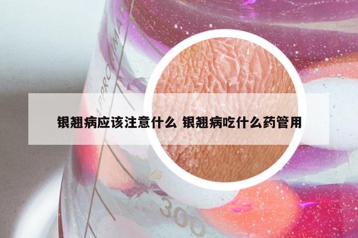 银翘病应该注意什么 银翘病吃什么药管用