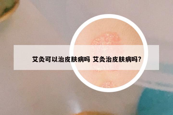 艾灸可以治皮肤病吗 艾灸治皮肤病吗?