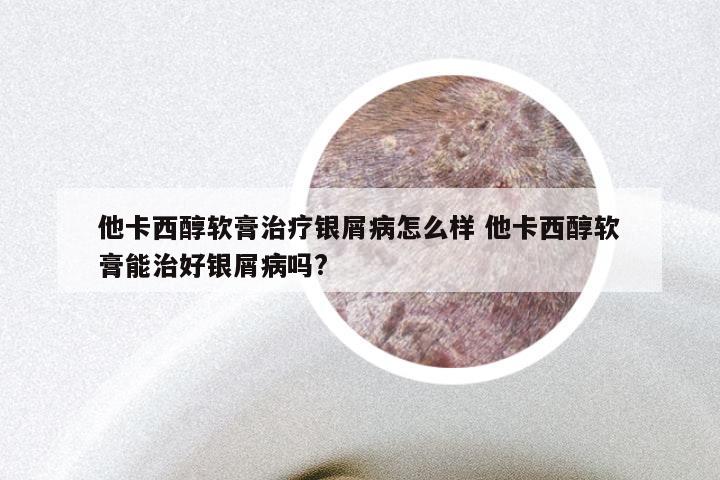 他卡西醇软膏治疗银屑病怎么样 他卡西醇软膏能治好银屑病吗?