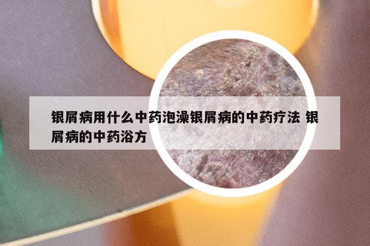 银屑病用什么中药泡澡银屑病的中药疗法 银屑病的中药浴方