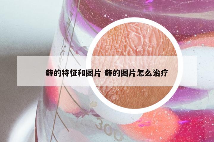 藓的特征和图片 藓的图片怎么治疗