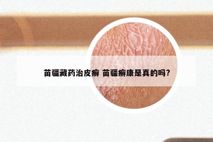 苗疆藏药治皮癣 苗疆癣康是真的吗?