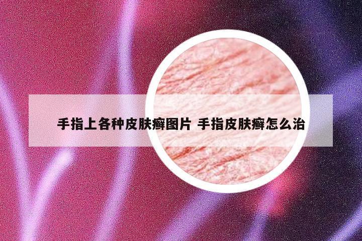 手指上各种皮肤癣图片 手指皮肤癣怎么治