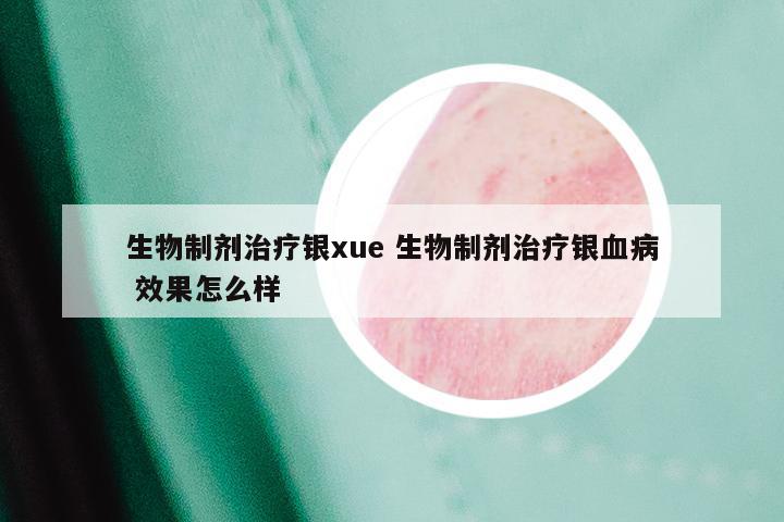 生物制剂治疗银xue 生物制剂治疗银血病 效果怎么样