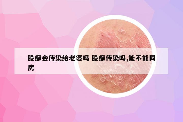 股癣会传染给老婆吗 股癣传染吗,能不能同房