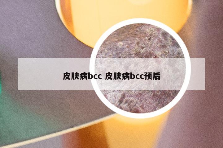 皮肤病bcc 皮肤病bcc预后