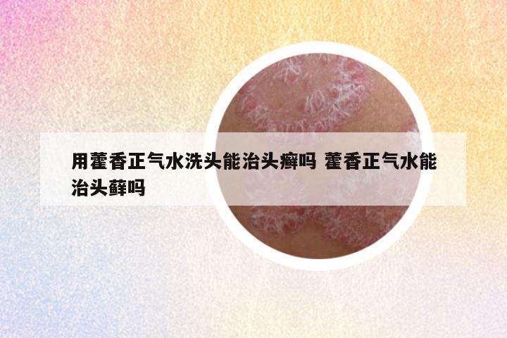 用藿香正气水洗头能治头癣吗 藿香正气水能治头藓吗