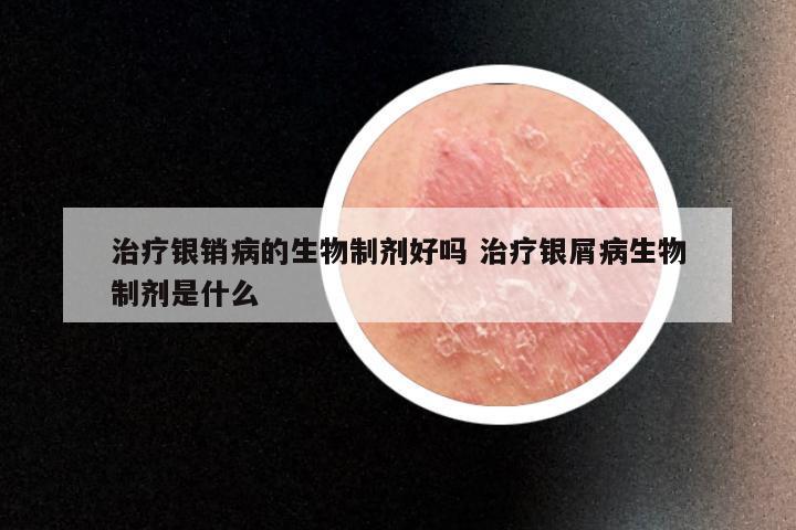 治疗银销病的生物制剂好吗 治疗银屑病生物制剂是什么