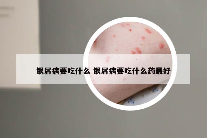 银屑病要吃什么 银屑病要吃什么药最好