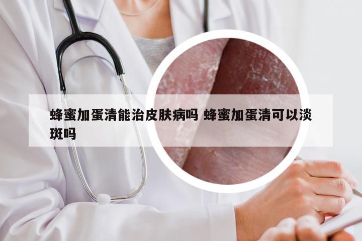 蜂蜜加蛋清能治皮肤病吗 蜂蜜加蛋清可以淡斑吗