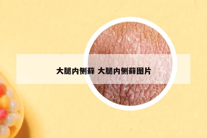 大腿内侧藓 大腿内侧藓图片