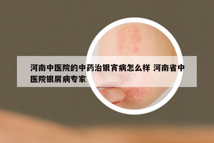 河南中医院的中药治银宵病怎么样 河南省中医院银屑病专家