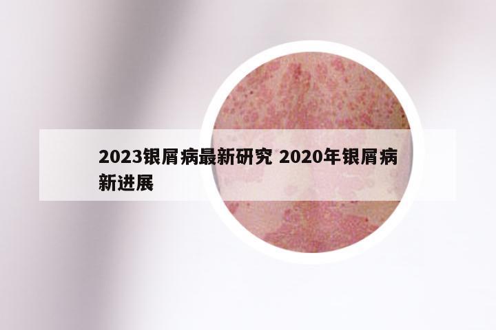 2023银屑病最新研究 2020年银屑病新进展