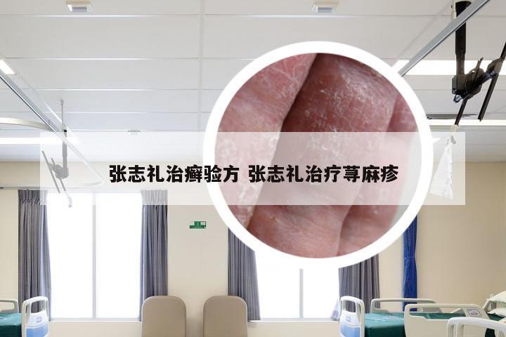 张志礼治癣验方 张志礼治疗荨麻疹