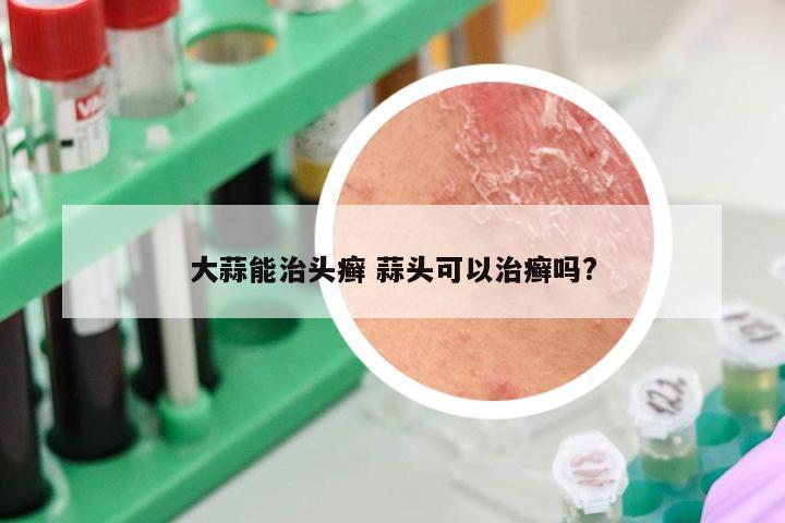 大蒜能治头癣 蒜头可以治癣吗?