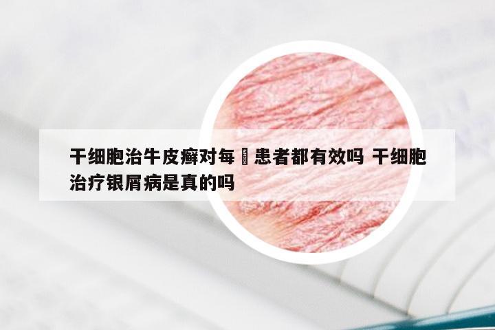 干细胞治牛皮癣对每亇患者都有效吗 干细胞治疗银屑病是真的吗