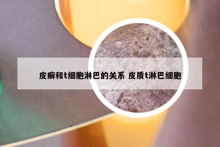 皮癣和t细胞淋巴的关系 皮质t淋巴细胞