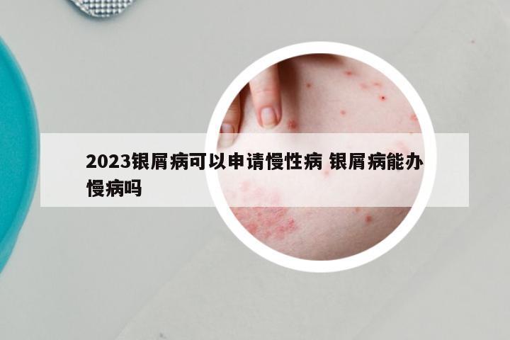 2023银屑病可以申请慢性病 银屑病能办慢病吗