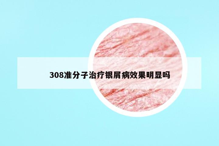 308准分子治疗银屑病效果明显吗