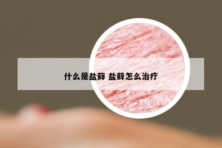 什么是盐藓 盐藓怎么治疗