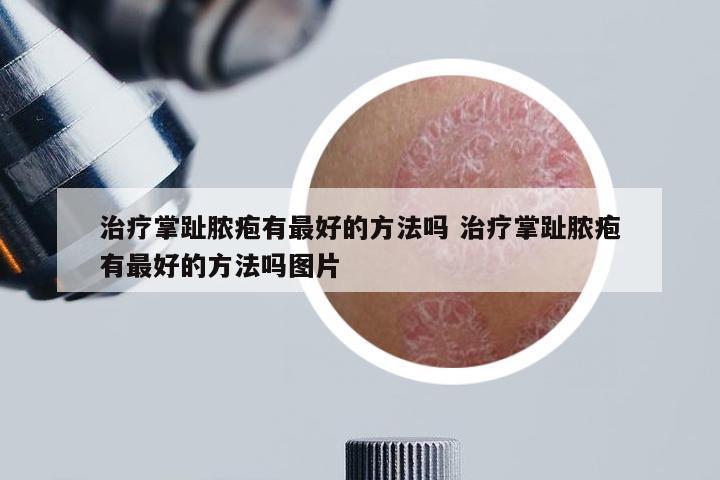 治疗掌趾脓疱有最好的方法吗 治疗掌趾脓疱有最好的方法吗图片