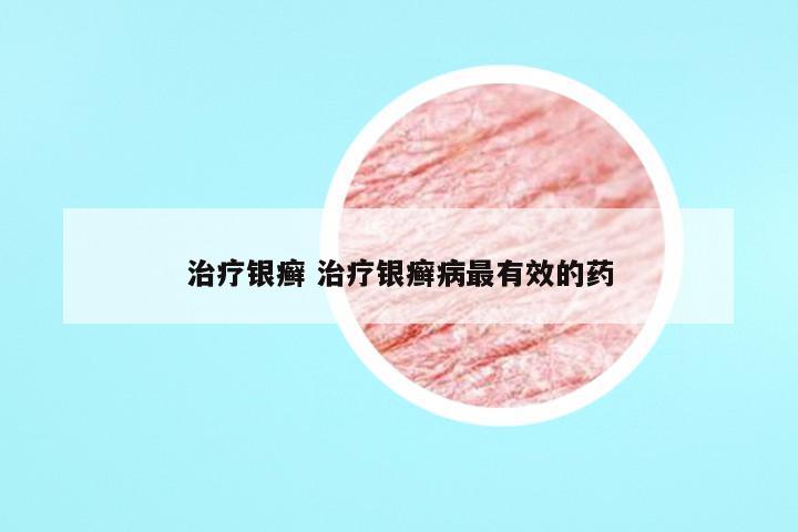 治疗银癣 治疗银癣病最有效的药