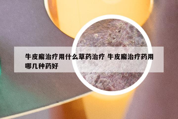 牛皮廨治疗用什么草药治疗 牛皮廨治疗药用哪几种药好