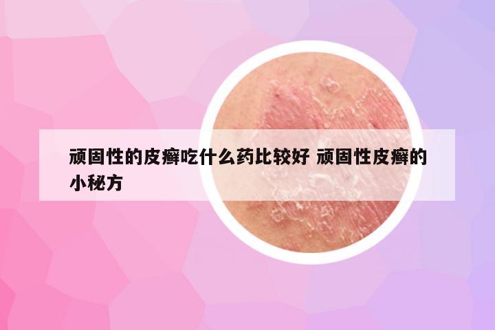 顽固性的皮癣吃什么药比较好 顽固性皮癣的小秘方