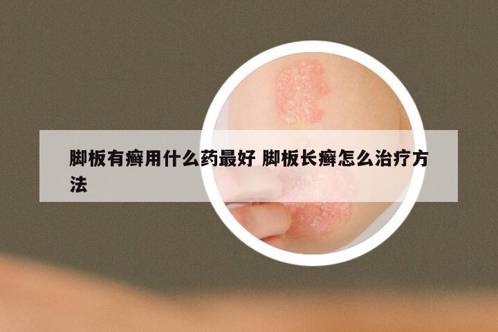 脚板有癣用什么药最好 脚板长癣怎么治疗方法