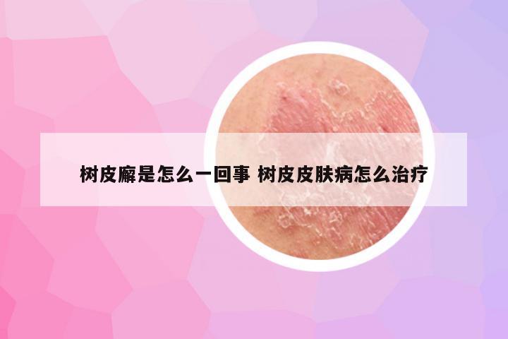 树皮廨是怎么一回事 树皮皮肤病怎么治疗