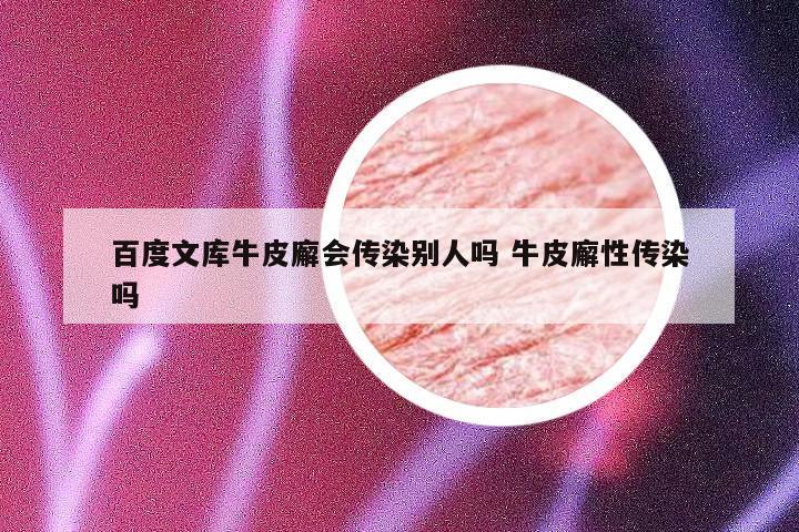 百度文库牛皮廨会传染别人吗 牛皮廨性传染吗